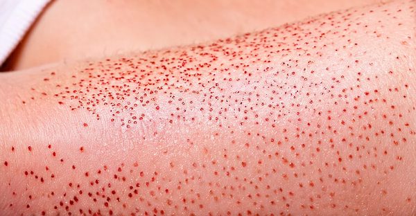 Traitement laser pour érythrose, couperose et rosacée à lyon